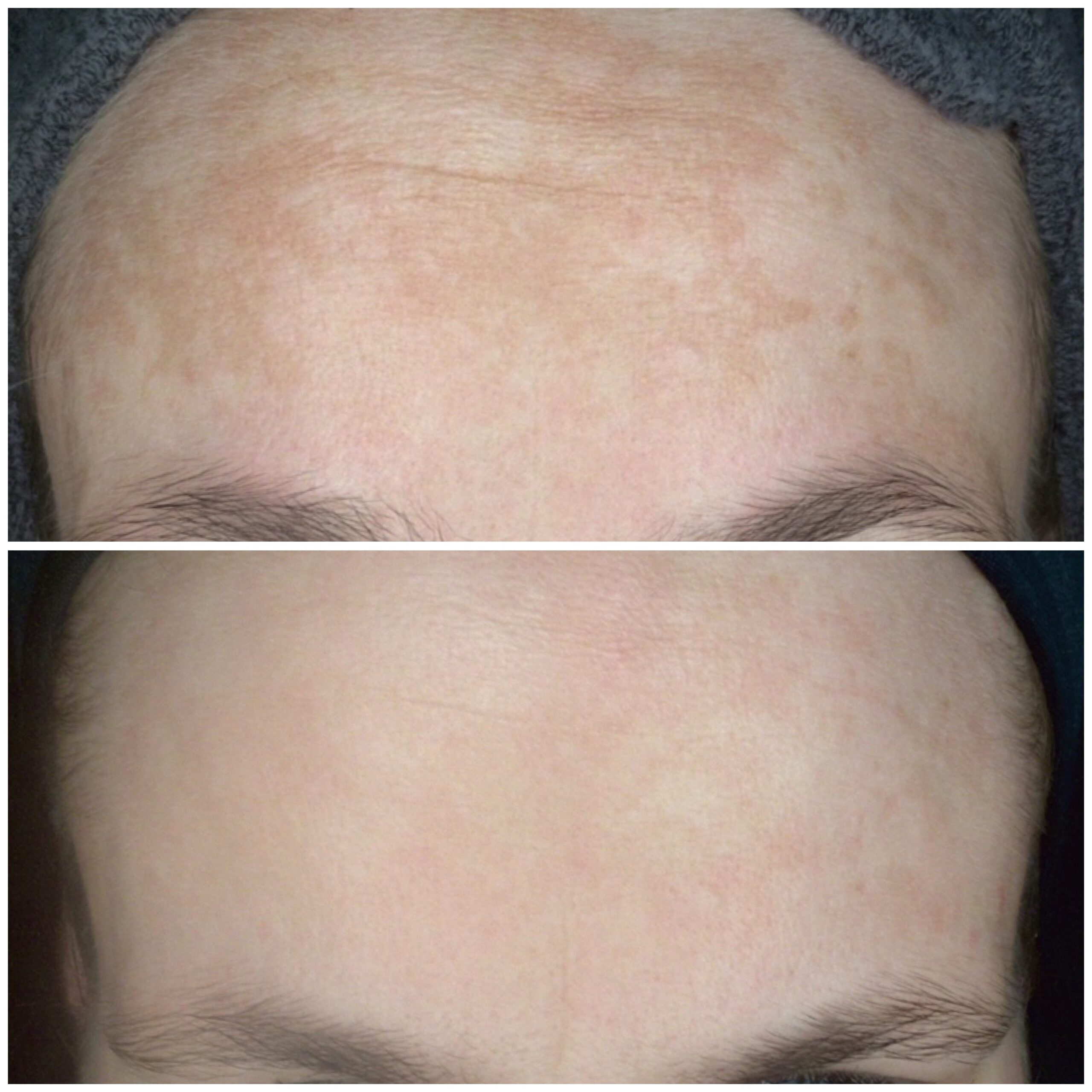 Melasma