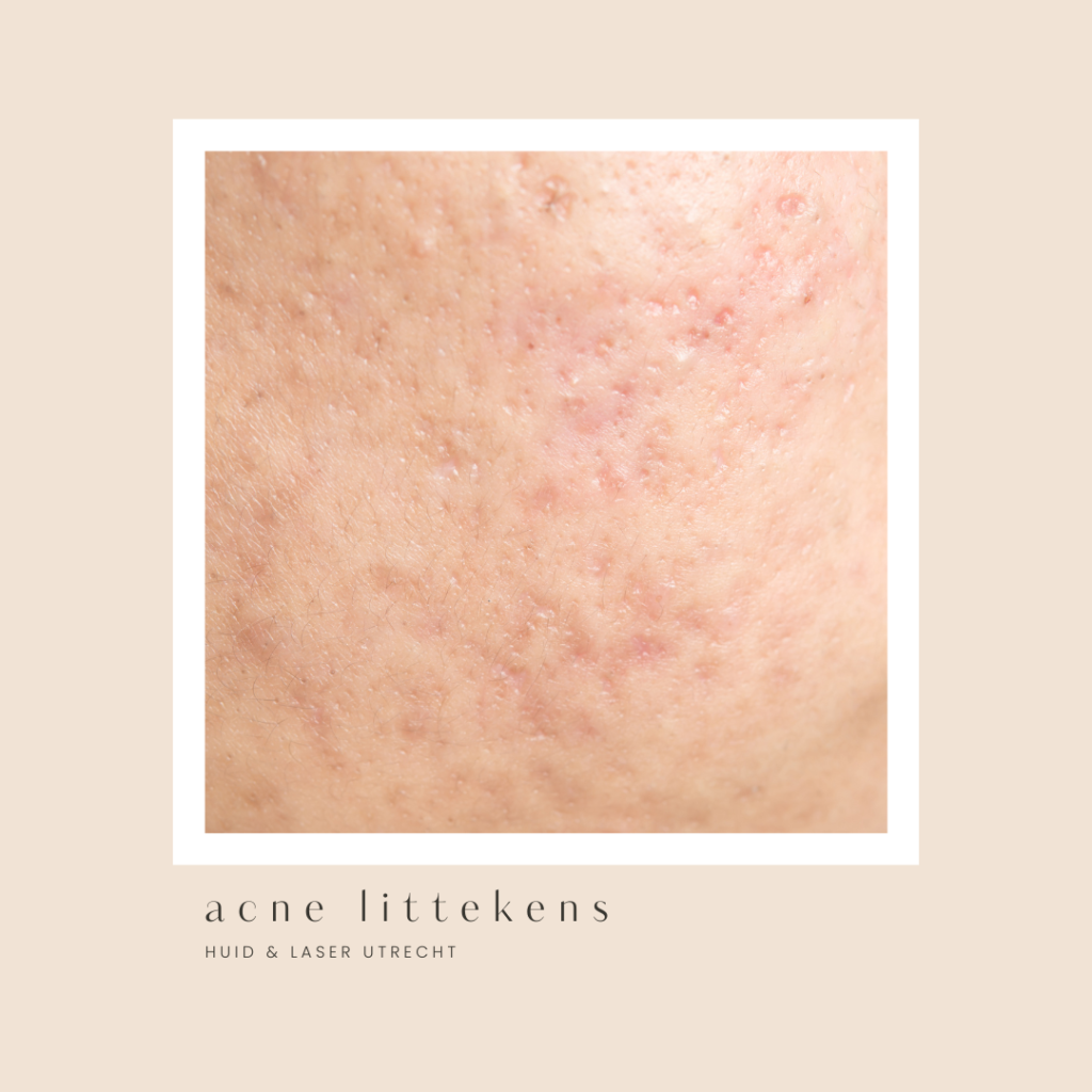 acne littekens behandeling