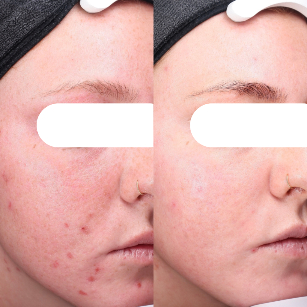 Acne behandeling