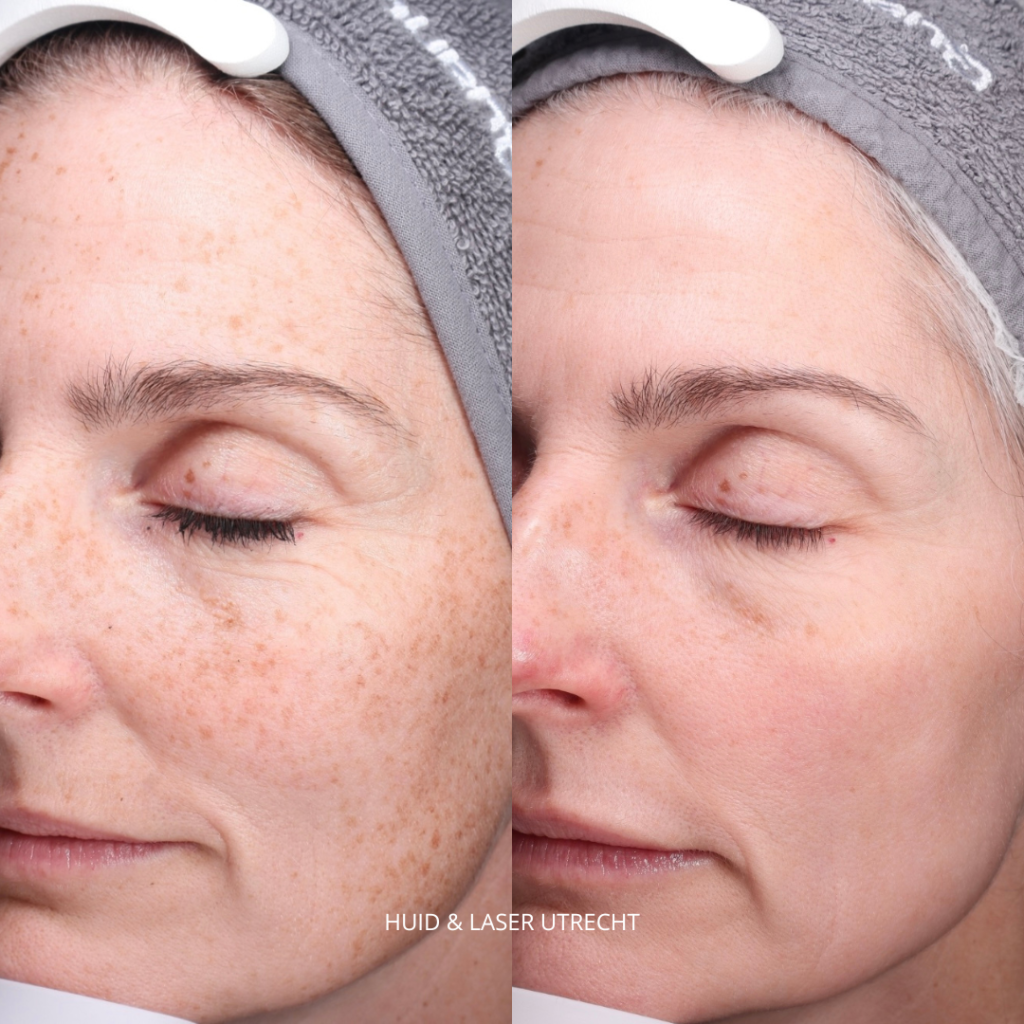 Voor en na Cosmo peel forte & RF microneedling