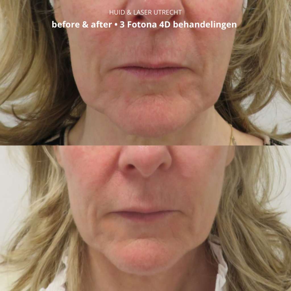 Voor- en na foto Fotona 4D