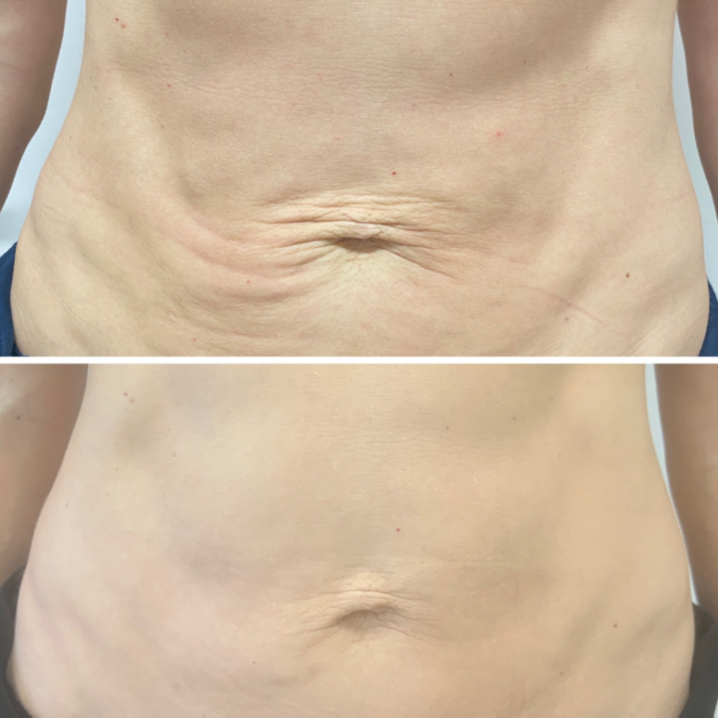 Huidverstrakking buik