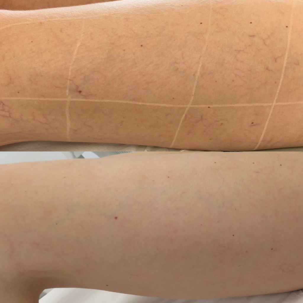 Beenvaten laserbehandeling