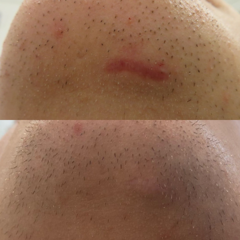 Voor en na foto litteken