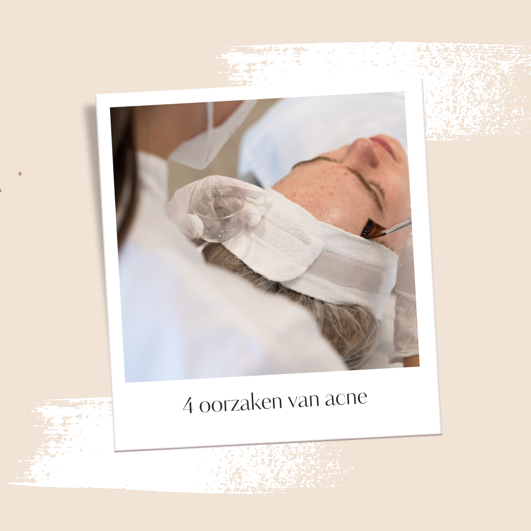 oorzaken van acne