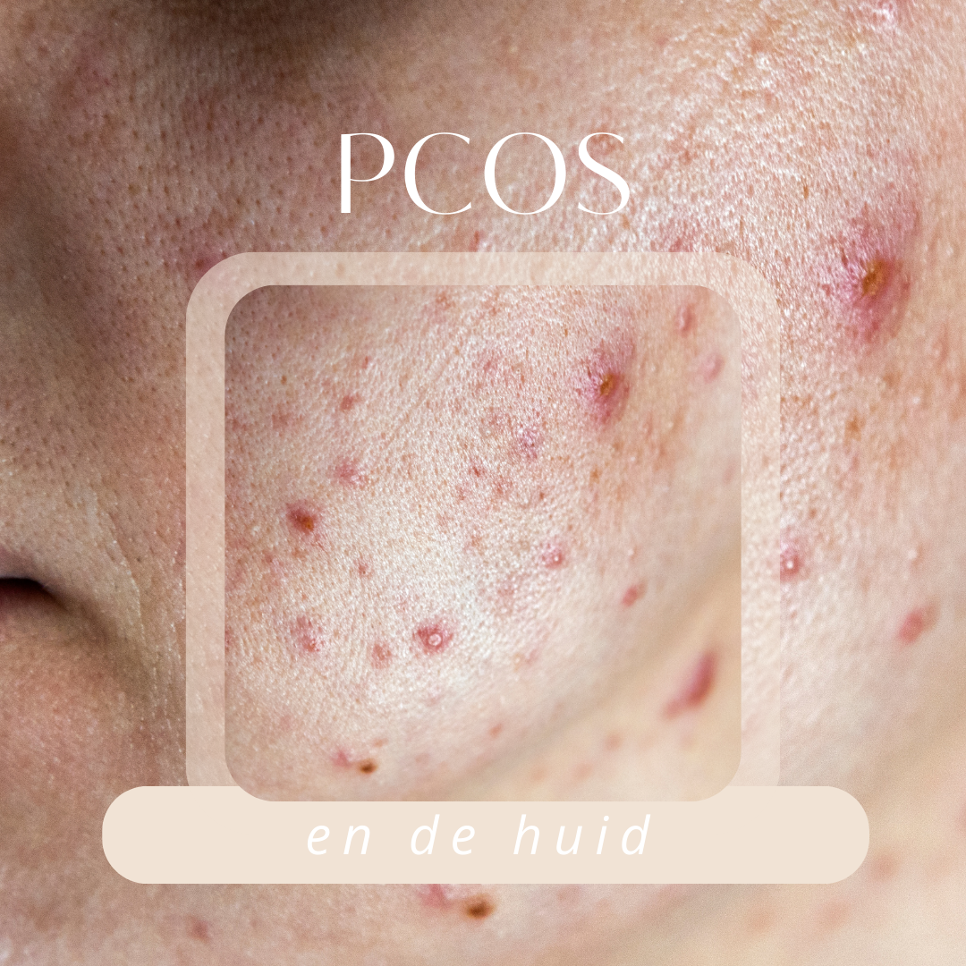 pcos en de huid