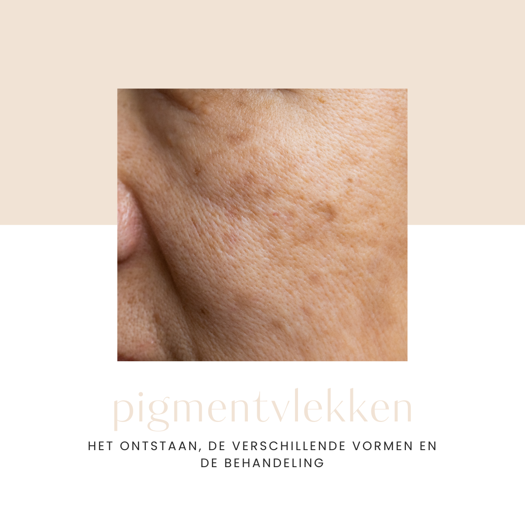 pigmentvlekken