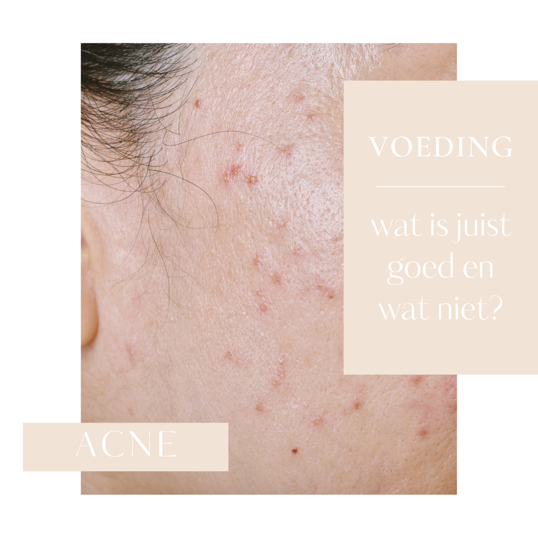 Voeding en acne