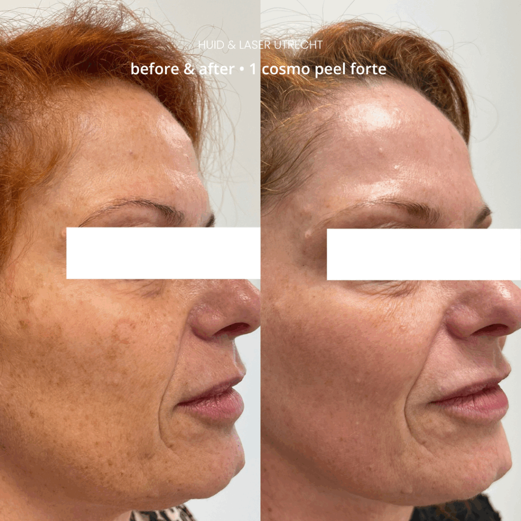 Voor- en na cosmo peel forte