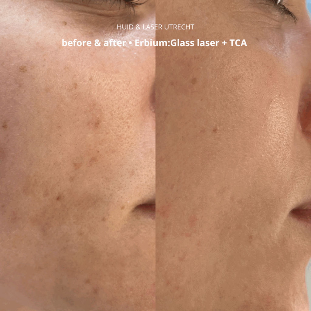 voor- en na foto TCA