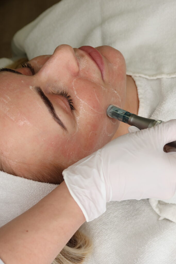 Microneedling PDRN