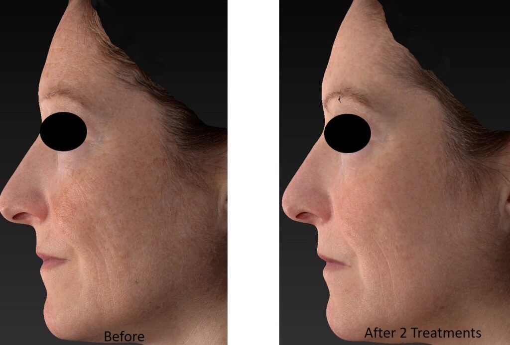 RF Microneedling 2