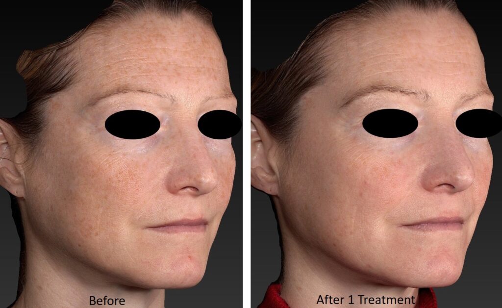 RF Microneedling 3
