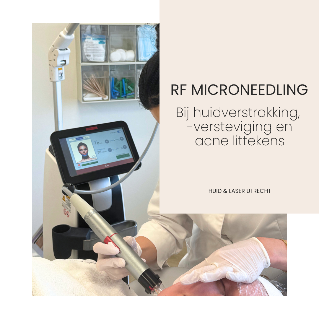 RF Microneedling