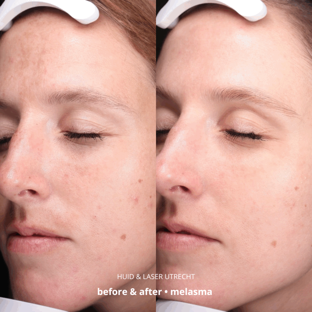 Before & After foto-2