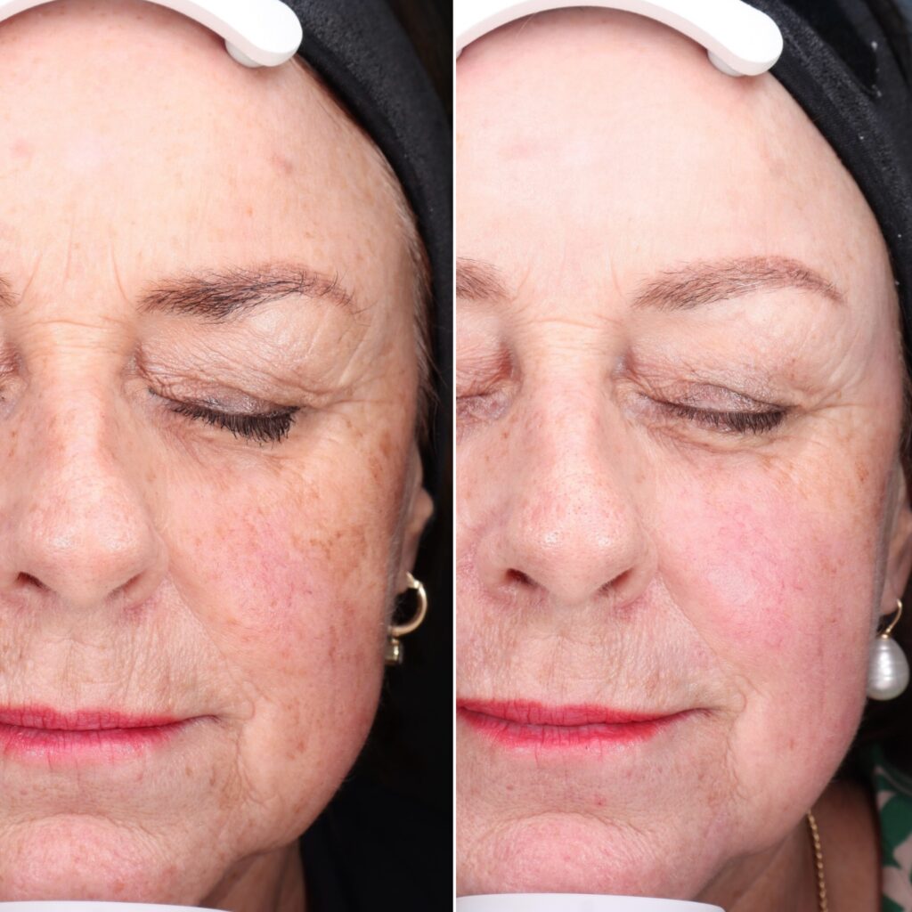 Cosmo peel forte voor- en na foto