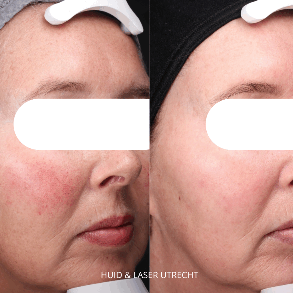 Na roodheid en pigment behandelingen