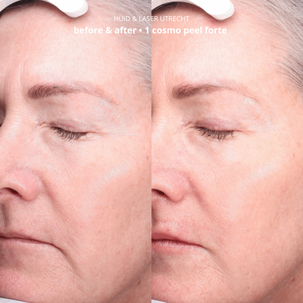 Dermaceutic cosmo peel forte