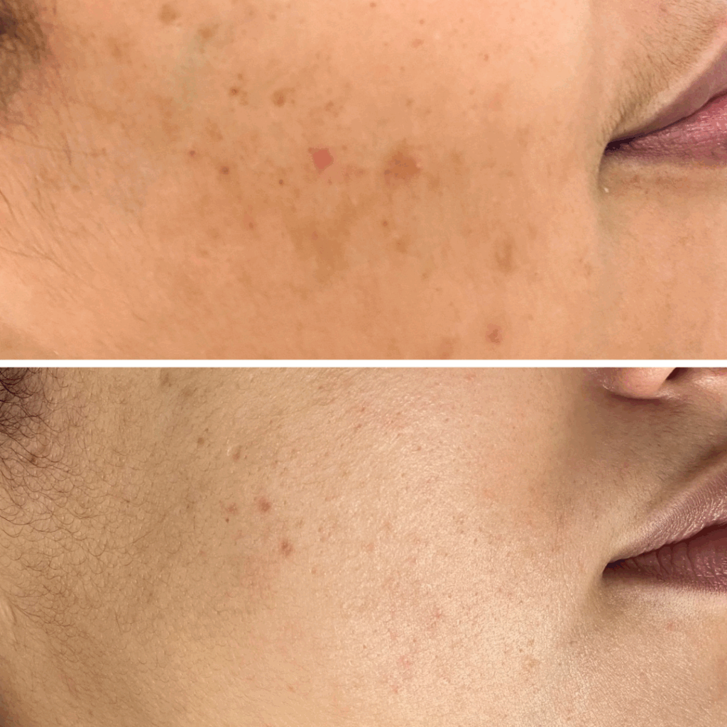 pih, postinflammatoire hyperpigmentatie