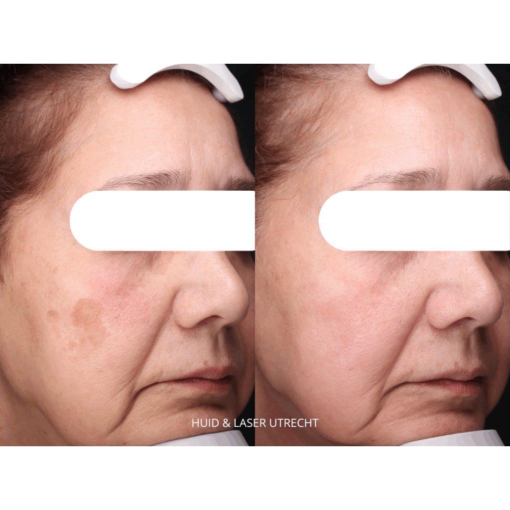 Zonnevlek voor en na foto