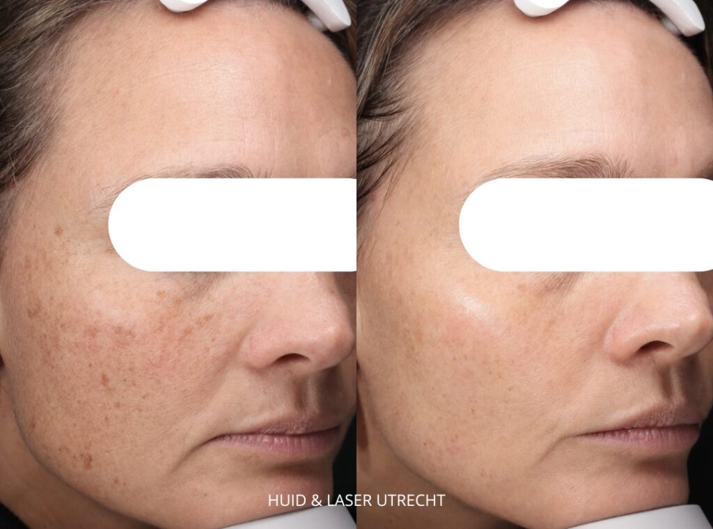 Hyperpigmentatie behandelen