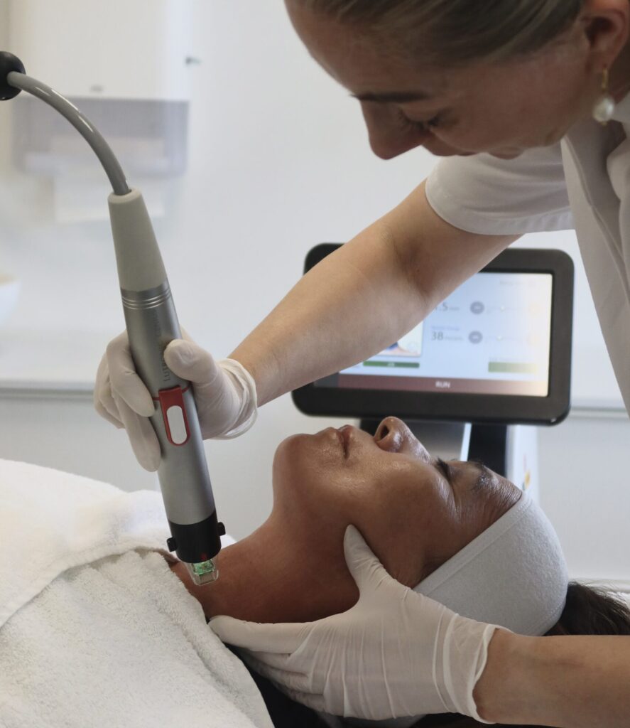 Genius RF Microneedling