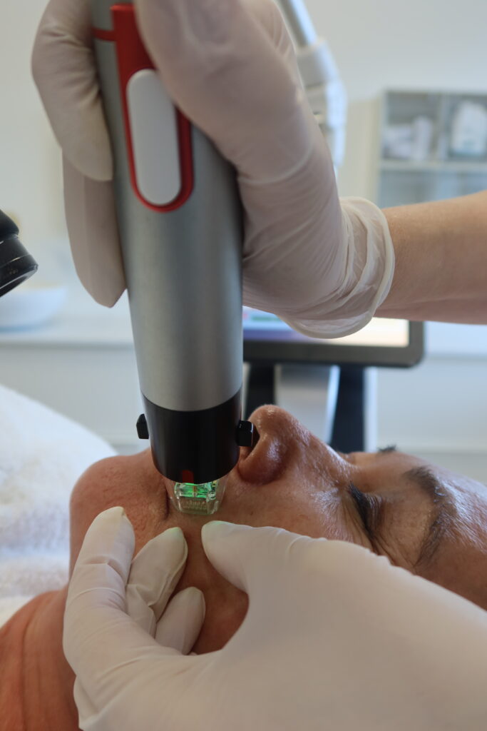 rf microneedling
