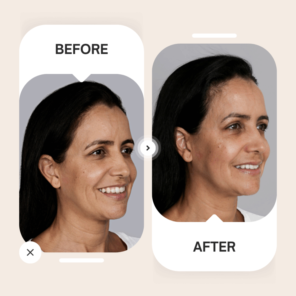 Sculptra before and after
