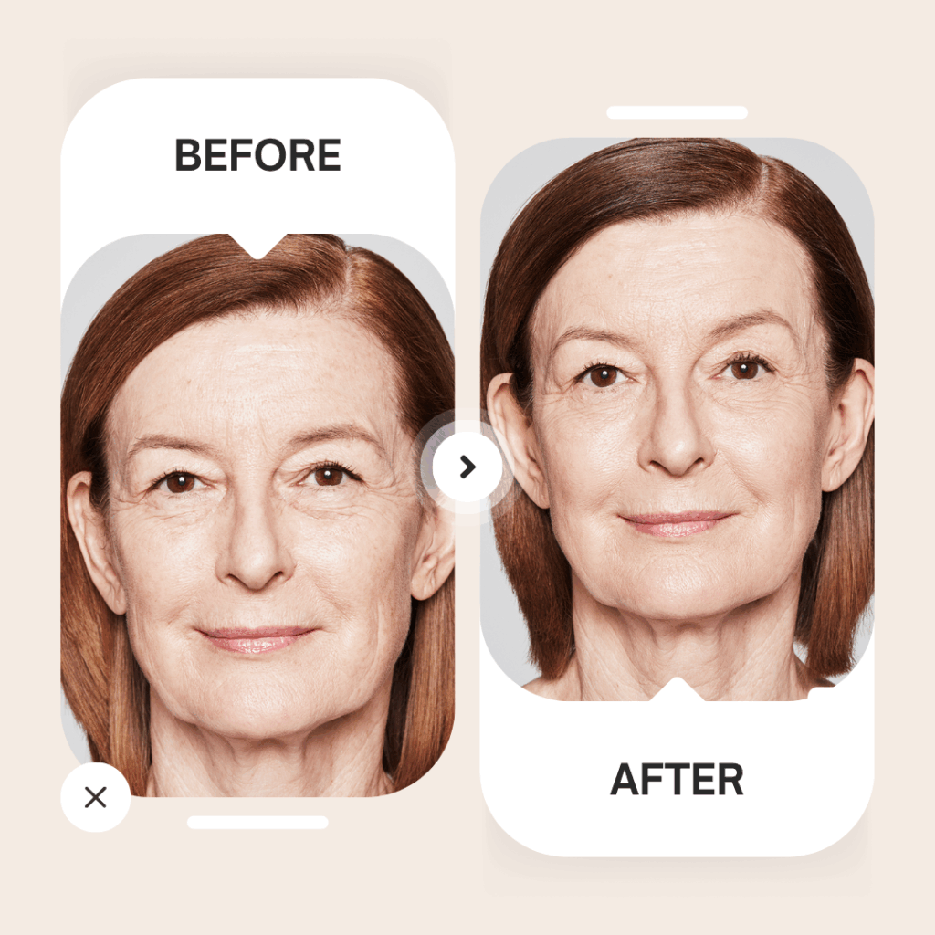 Sculptra voor en na foto