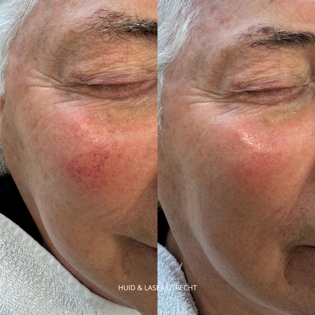 couperose behandeling